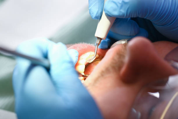 Best Emergency Treatment for Dental Infections or Abscesses in Cascades, VA